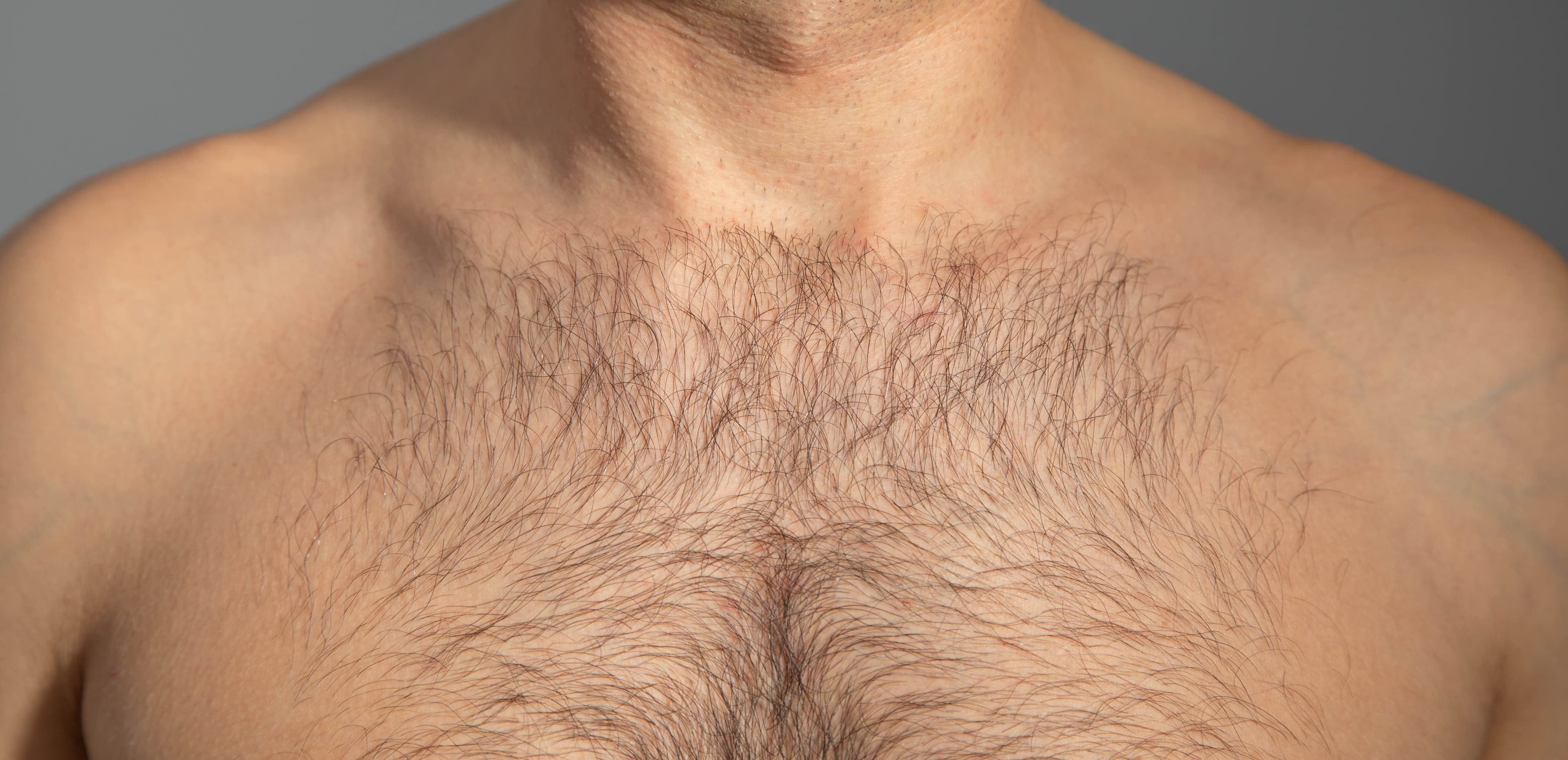 Dlaka na grudima kao donor zona za BHT transplantaciju kose