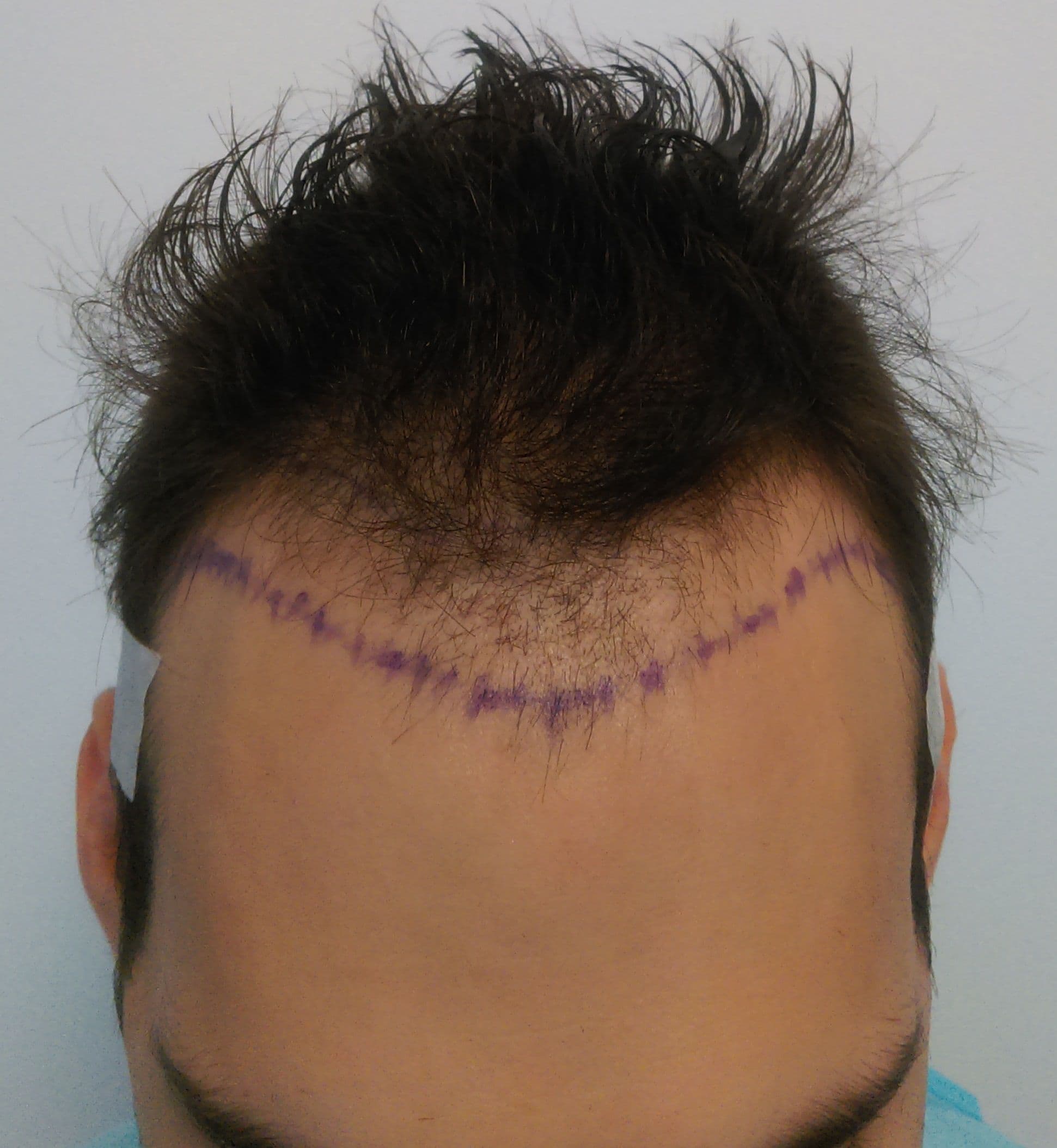 Before treatment - Patient 2