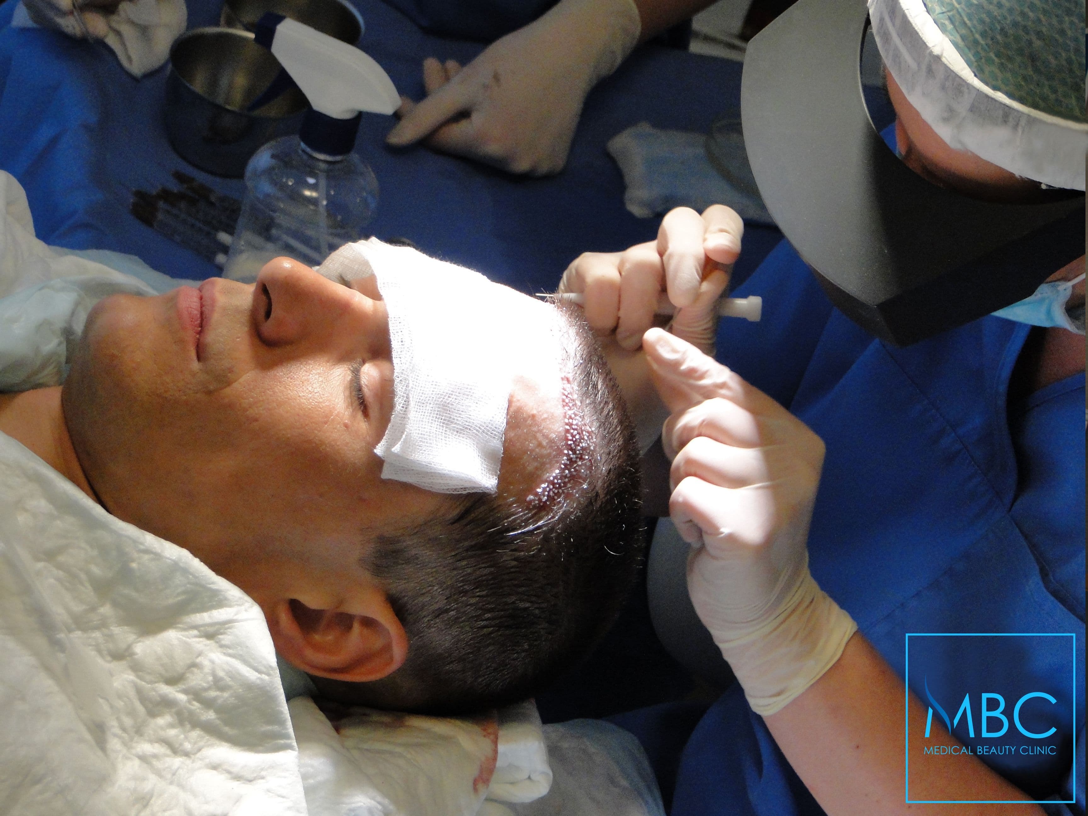 Dr Marija Balkovic izvodi FUE Precise metodu transplantacije kose