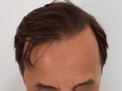 After treatment - Patient 4