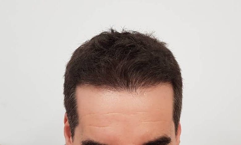 After treatment - Patient 1