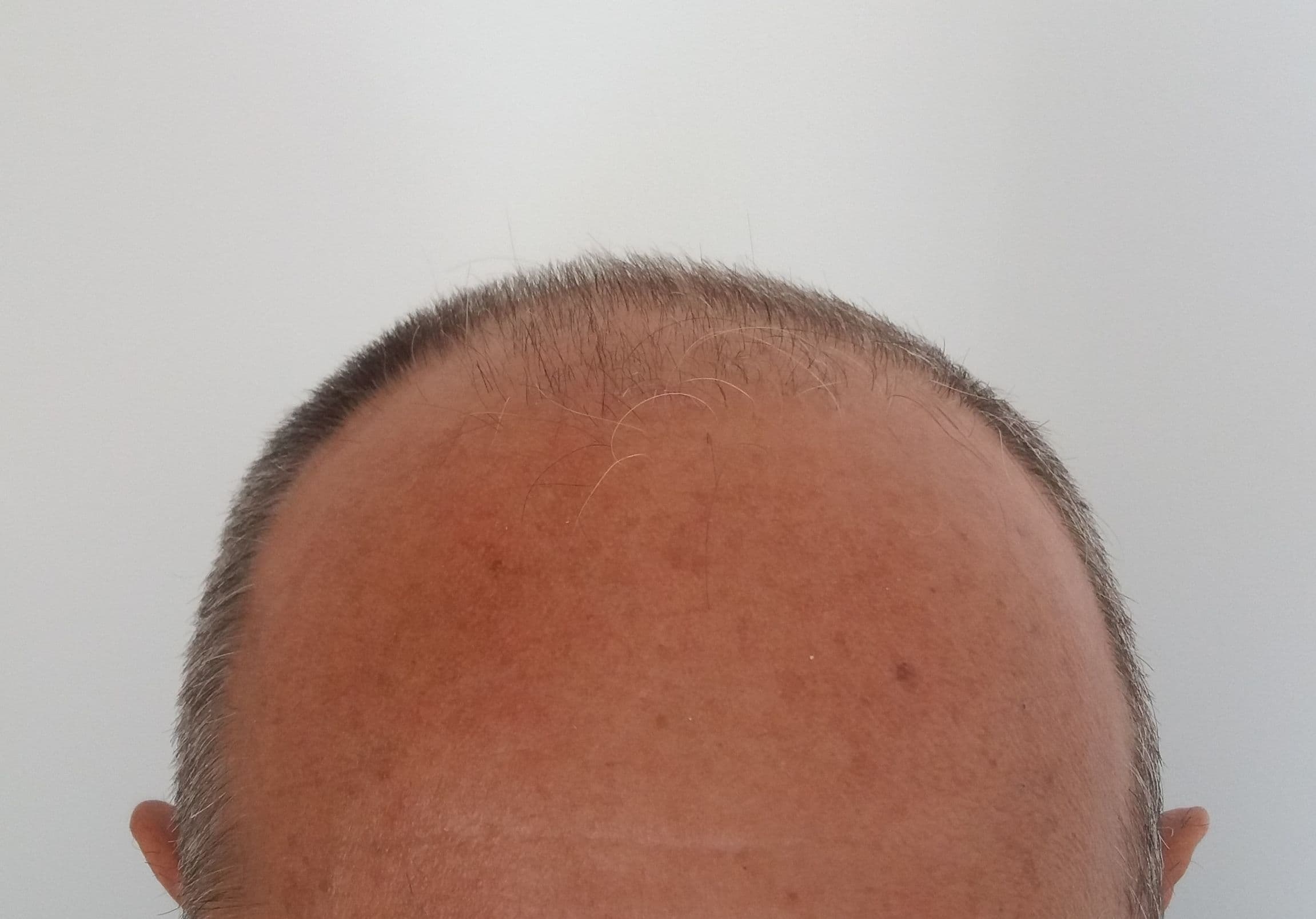 Before treatment - Patient 2