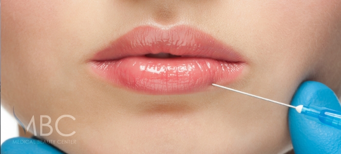 Dermal fillers