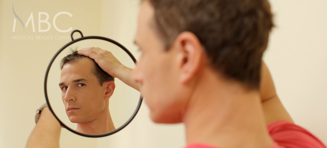 Haarverlust bei Männern