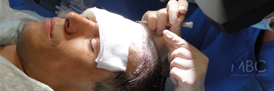 Hair transplant procedure